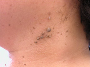 Skin Tags & Wart Removal
